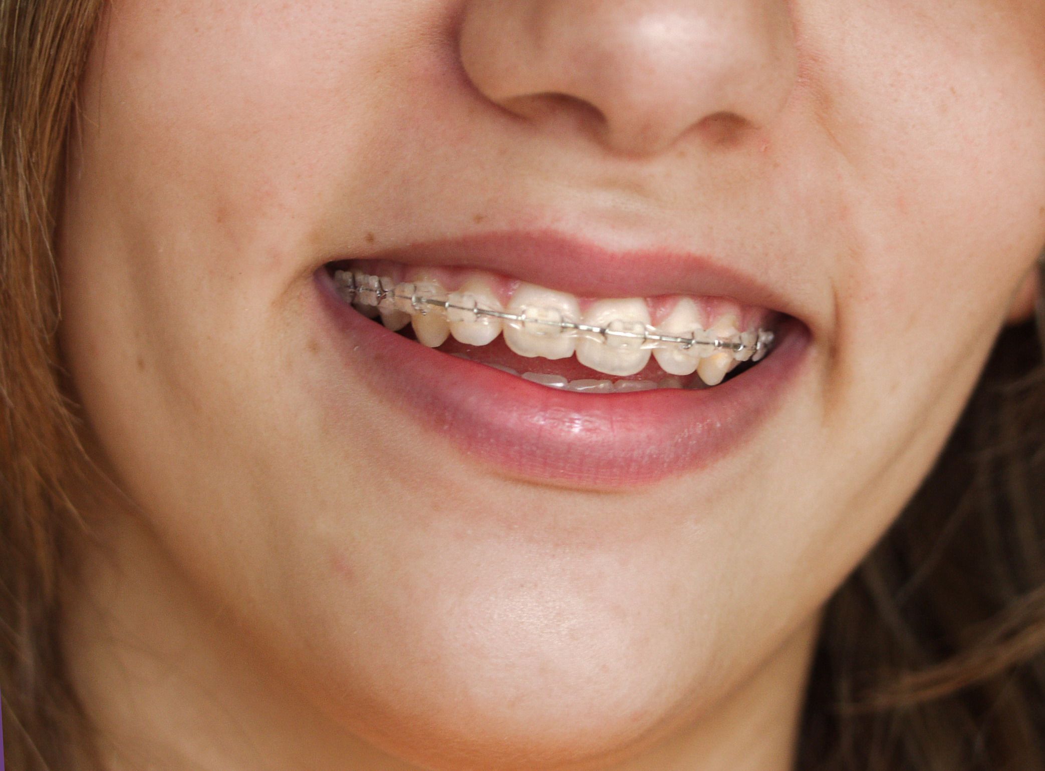 Reasons To See Orthodontic Specialists In Strongsville OH