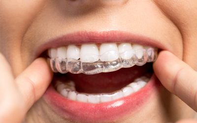 Achieve Your Dream Smile with Invisalign Buffalo Grove IL Clear Aligner Solutions