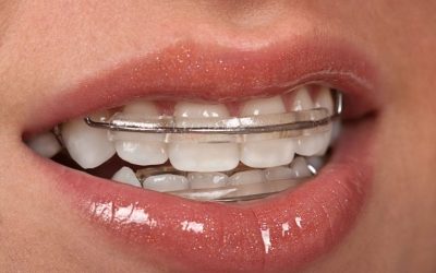 Unlock New Confidence With Braces For Adults In Medina OH For A Healthier Smile