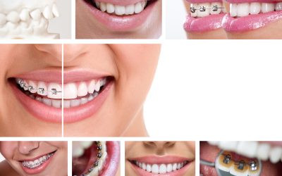 Transform Your Confidence at Any Age With Braces in Natchitoches, LA